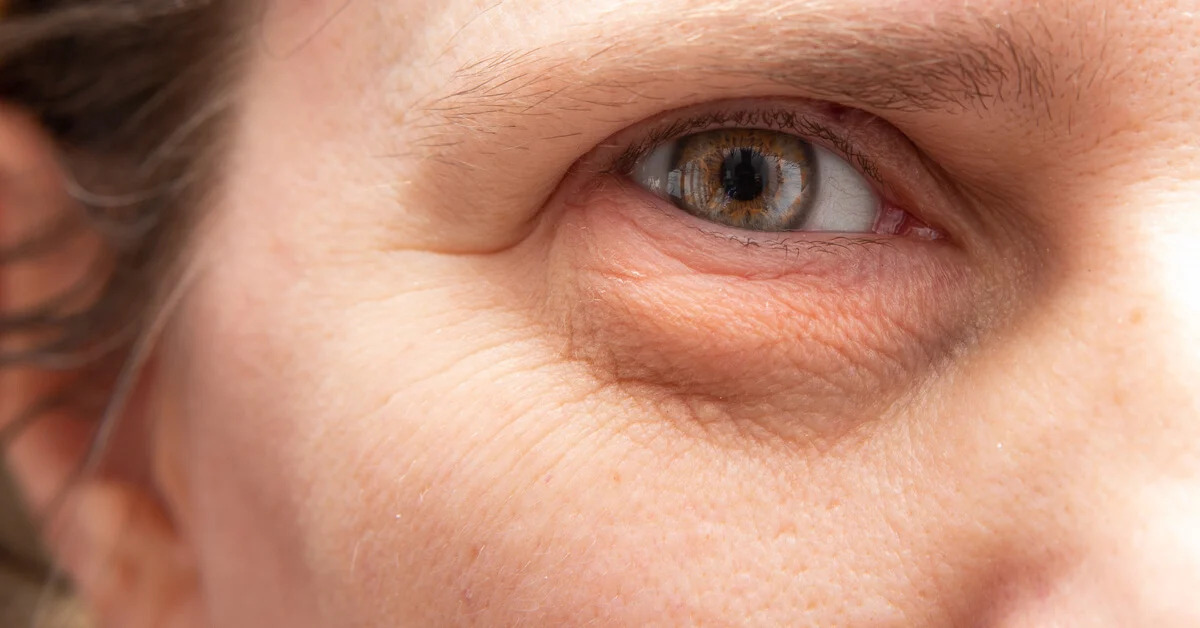 الانتفاخ تحت العين