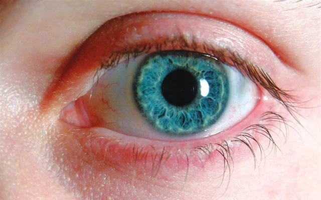 منها فقدان البصر المفاجئ.. تعرف إلى أعراض المياه الزرقاء في العين