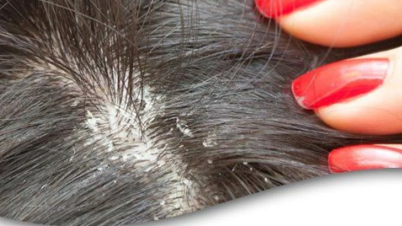 علاج القشرة