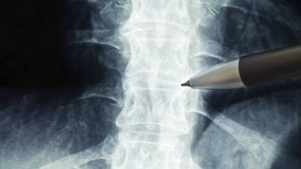 جامعة سيريوس الروسية تطويراً جديداً لعلاج إصابات النخاع الشوكي