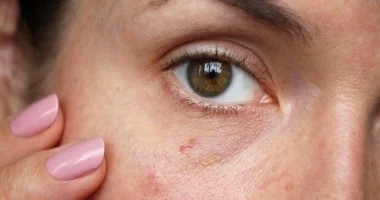 مشاكل جلد الخريف: أسبابها، علاجاتها، وكيف تحمي بشرتك